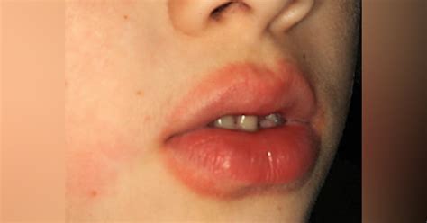 Swollen Burning Top Lip