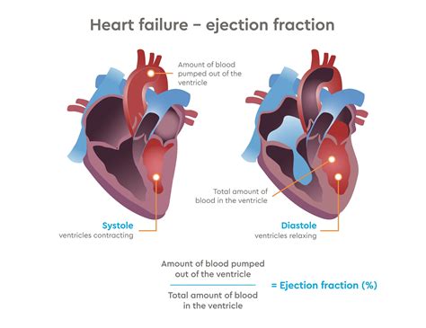 Heart failure develops when the heart, via an abnormality of cardiac function (detectable or not), fails to pump blood at a rate commensurate with the 5 the committee for practice guidelines (cpg) of the european society of cardiology (esc) as well as the american college of cardiology, american. Heart Failure | GenesisCare