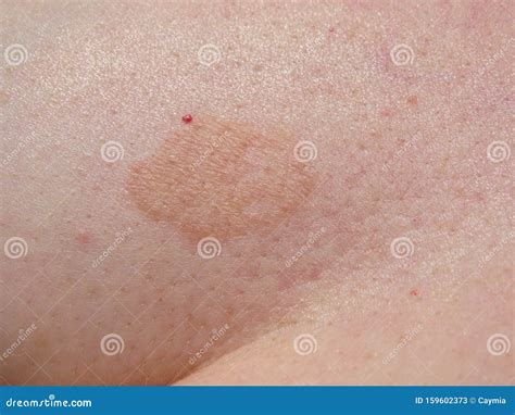 Fungal Skin Rash Infection Mark Close Up Of Patch Stock Image Image