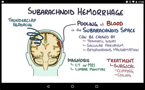 Q Subarachnoid Haemorrhage Etiology Pathogenesis Clinical
