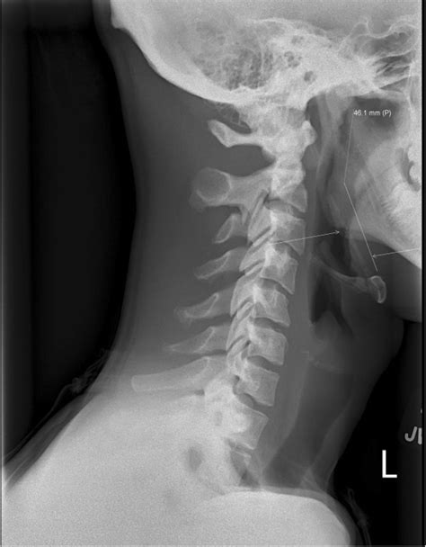 Elongated And Calcified Stylohyoid Ligament On Lateral Neck Radiograph