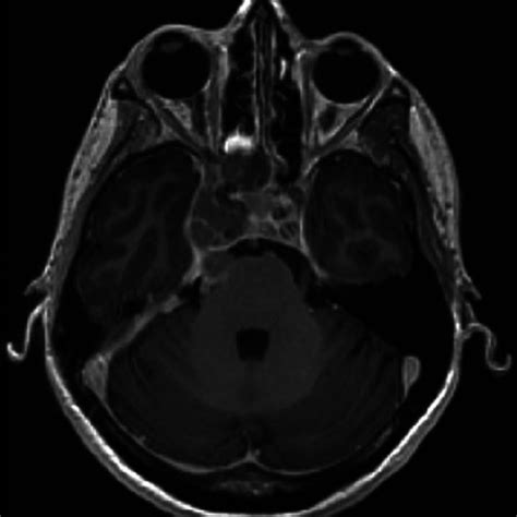 Axial T1 Weighted Magnetic Resonance Imaging Scan Showing A Complex