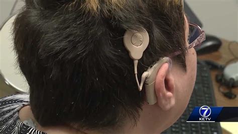 Benefits Of Cochlear Implants In Adulthood