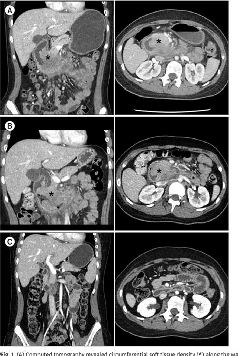 Figure 1 From Anaplastic Large Cell Lymphoma Of The Duodenum In A