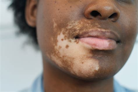 Photographer Jasmine Colgan Captures The Faces Of People With Vitiligo