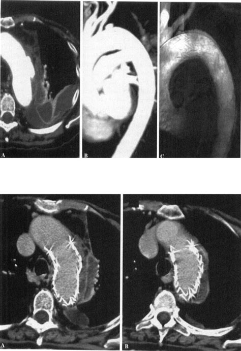 Case 2 A Contrastenhanced Spiral Ct Scan Shows Pau In The Distal Arch