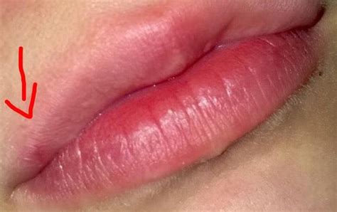 Pickel an der lippe können durch übermäßige ölproduktion. Herpes, Pickel oder was anderes? (Haut, Dermatologie, Lippe)