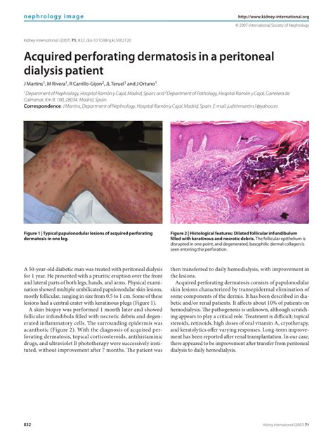 Pdf Acquired Perforating Dermatosis In A Peritoneal Dialysis Patient