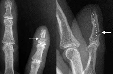 Finger Distal Phalanx Fractures Hand Surgery Resource