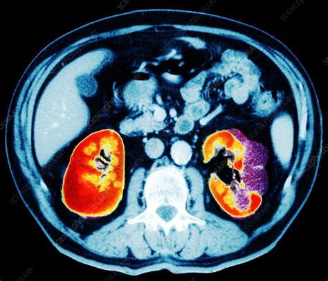 Kidney Cancer Abdominal Ct Scan Stock Image M1340458 Science
