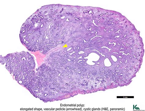Pathology Outlines Endometrial Polyp