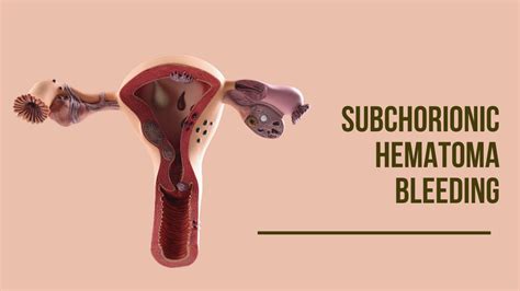 Subchorionic Hematoma Bleeding Vs Miscarriage In Pregnancy Facts To Know