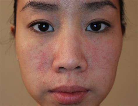 Mild Allergic Reaction On Face