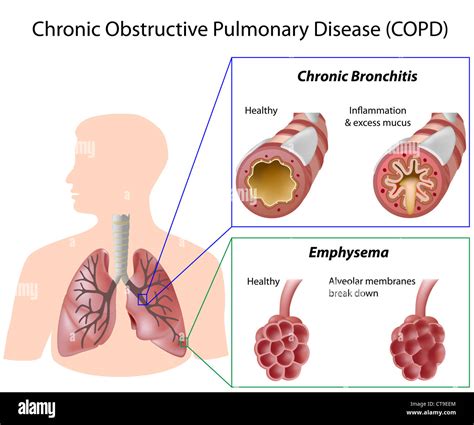 Chronic Obstructive Pulmonary Disease Stock Photo Alamy