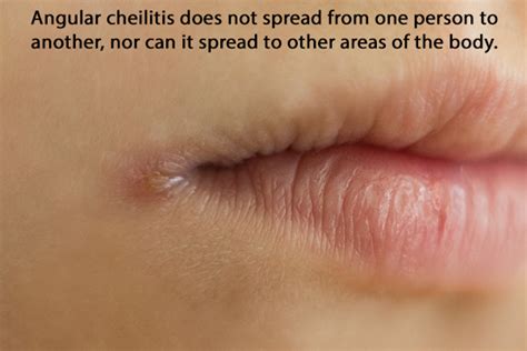 4 Home Remedies For Angular Cheilitis And 6 Self Care Tips