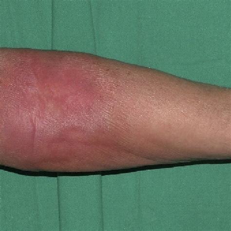 A Extensive Ulcer Of The Dorsum Of The Wrist After Extravasation Of