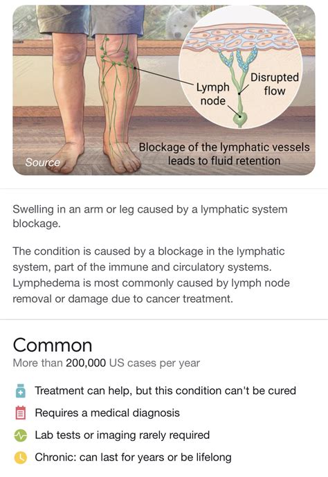 Its About The Lymphedema Ihavebreastcancerblog