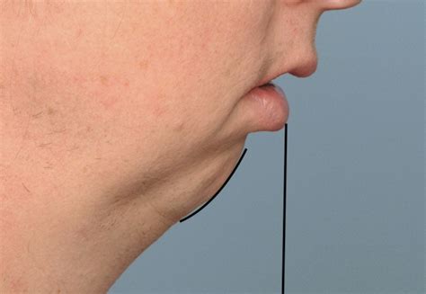 Flat Male Chin Shape Dr Barry Eppley Indianapolis Explore Plastic Surgery
