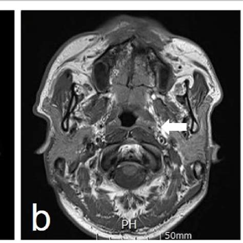 Pdf The Value Of Ct Mri And Pet Ct In Detecting Retropharyngeal