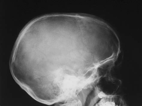 Soft Tissue Signs Skull And Facial Bones Wikiradiography