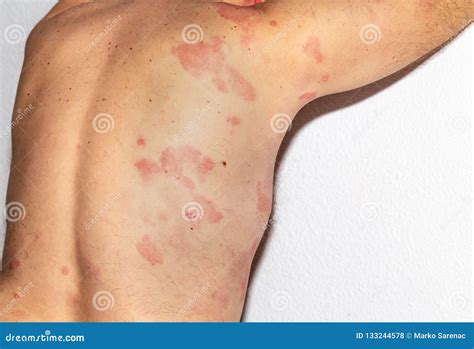 Allergy Intolerance Reaction Histamine Health Stock Photo Image