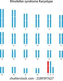 Scientific Designing Klinefelter Syndrome Xxy Karyotype Stock Vector