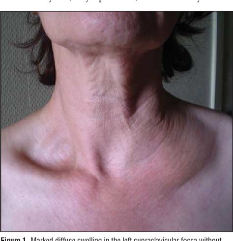 Figure 1 From Recurrent Lymphangiectasia Of The Left Supraclavicular