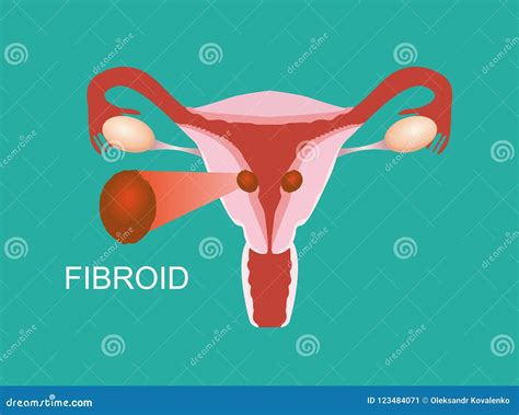 Illustration Of The Uterine Fibroid Intramural Myoma Stock Vector