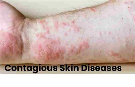 Skin Infections Types Introduction Types Side Effects And More