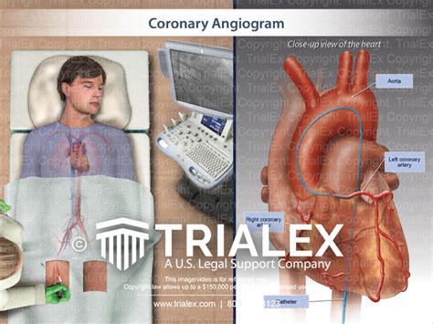Coronary Angiogram Trialexhibits Inc