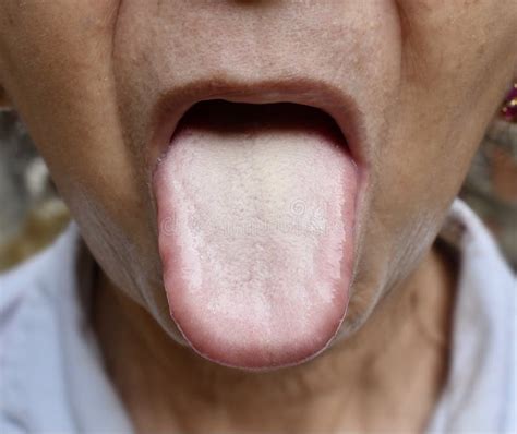 Coated Tongue Or White Tongue Loss Of Taste Called Ageusia Stock Image Image Of Pale Mouth