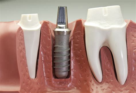 Tratamentul Prin Implant Dentar Etape Stomatolog Tefan Cel Mare V C Rescu Doroban I