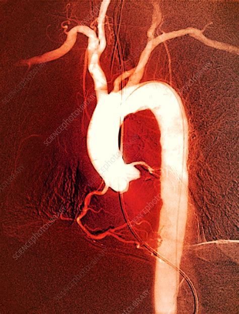 Aortic Arch X Ray Stock Image C0299961 Science Photo Library