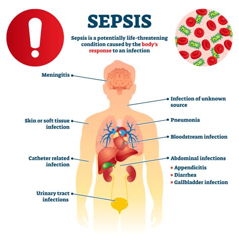 Everything About Sepsis Infection