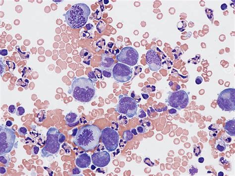 B Cell Lymphoma In Pleural Fluid Stock Photo Image Of Fluid Tumor