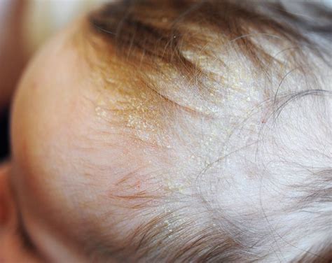 Heres How To Identify Baby Skin Problems Huffpost Uk Parents