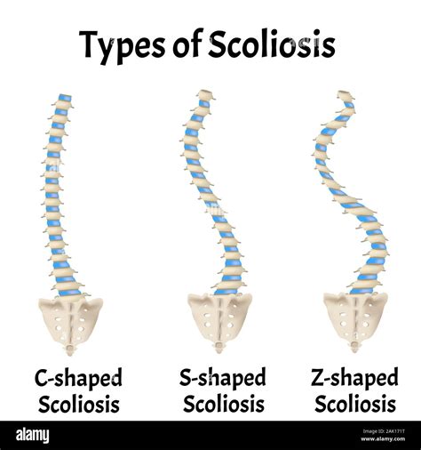 Types Of Scoliosis C S Z Shaped Scoliosis Dextroscoliosis