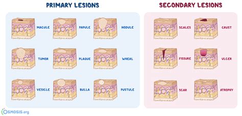 Skin Lesions What Are They Types Causes Diagnosis Treatment And