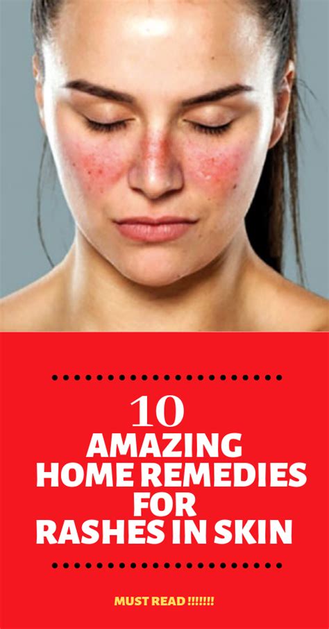 10 Amazing Home Remedies For Rashes Heat Rash Also Known As Prickly Heat Is A Problem That I