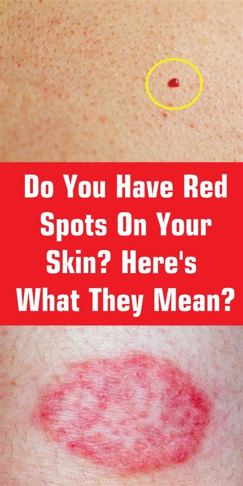 Do You Have Red Spots On Your Skin Heres What They Mean Healthy