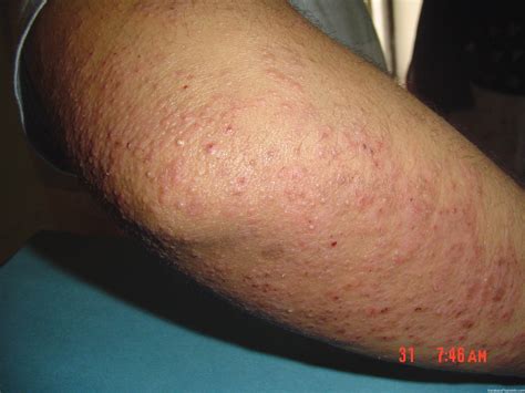 Another Case Of Severe Kp On The Legs Keratosis Pilaris Treatment Options