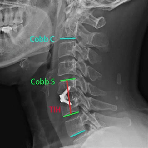 Lateral X Rays Of The Cervical Vertebra Cobb C The Cobb Angle Between