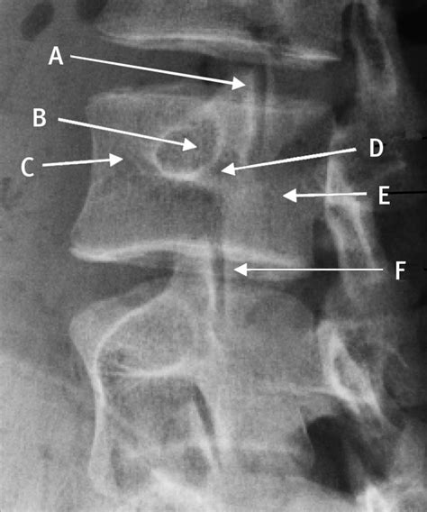 Lumbar Spine Anatomy Xray