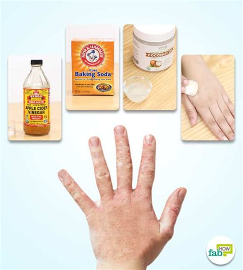 How To Get Rid Of Fungal Infection Kill The Fungus Naturally Fab How