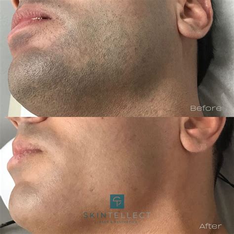 Laser Hair Removal Tampa Before And After Pictures