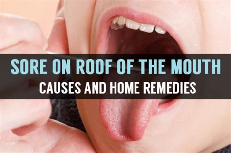 what is roof of the mouth sore know its causes and remedies