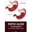 Peptic/Stomach Ulcer During Pregnancy  Causes Symptoms Diagnosis