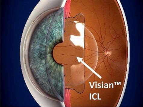 Phakic Implantable Collamer Lens Icl Carlinvision