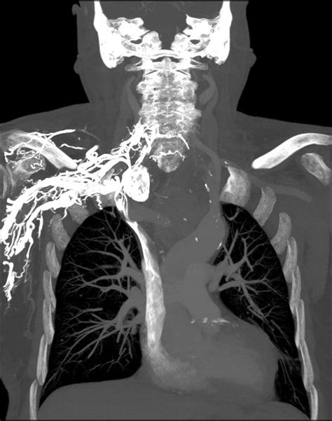 Retrosternal Thyroid Mass Resulting In Axillosubclavian Vein Thrombosis