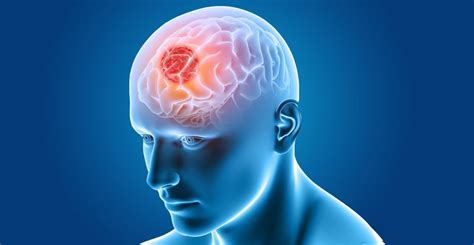 Understanding Brain Tumours And Their Risk Factors